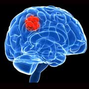 Brain tumour